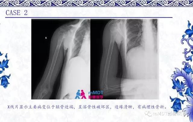 【PPT】长骨骨端髓内肿瘤的影像学诊断