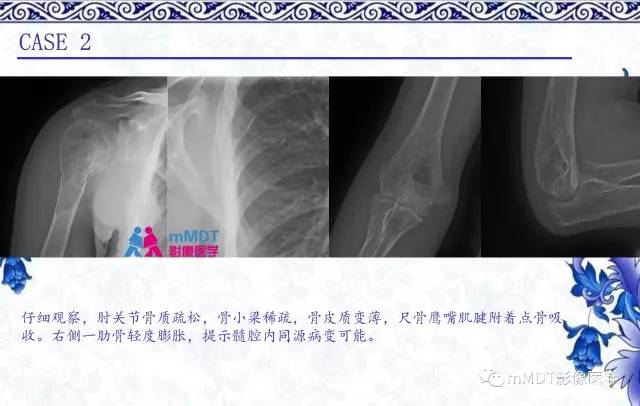 【PPT】长骨骨端髓内肿瘤的影像学诊断