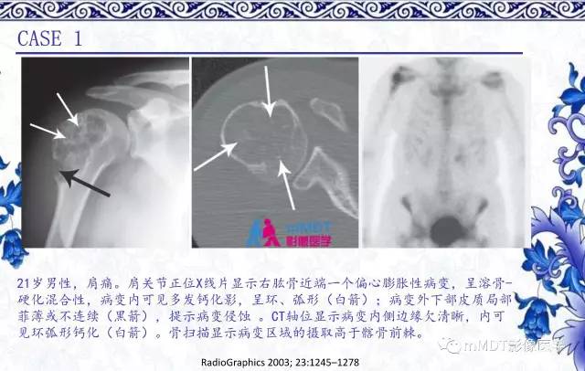 【PPT】长骨骨端髓内肿瘤的影像学诊断