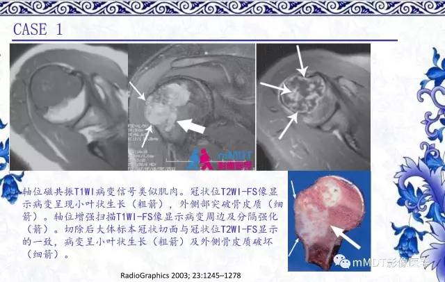 【PPT】长骨骨端髓内肿瘤的影像学诊断