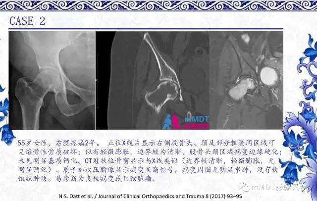 【PPT】长骨骨端髓内肿瘤的影像学诊断