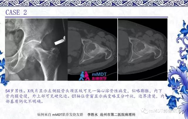 【PPT】长骨骨端髓内肿瘤的影像学诊断