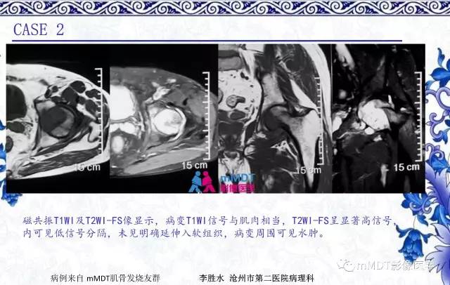 【PPT】长骨骨端髓内肿瘤的影像学诊断
