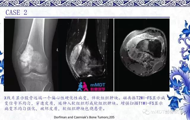 【PPT】长骨骨端髓内肿瘤的影像学诊断
