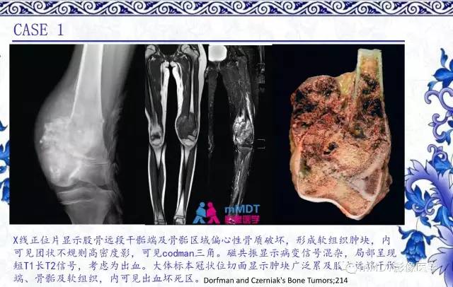 【PPT】长骨骨端髓内肿瘤的影像学诊断
