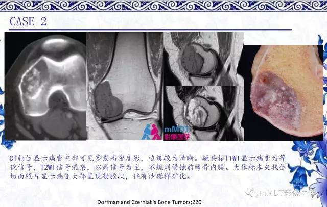 【PPT】长骨骨端髓内肿瘤的影像学诊断