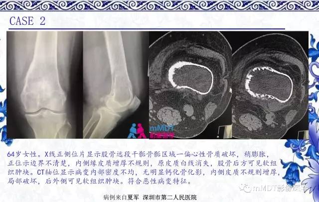 【PPT】长骨骨端髓内肿瘤的影像学诊断