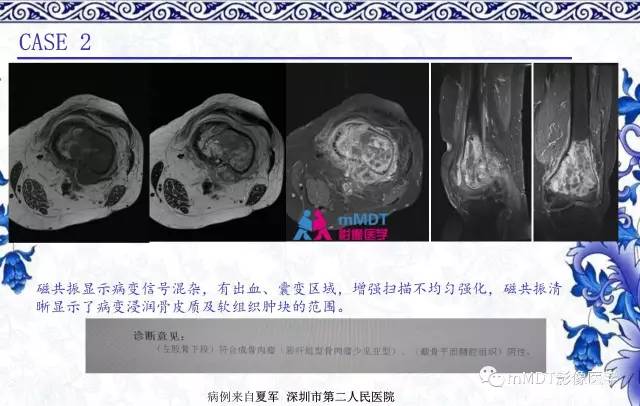 【PPT】长骨骨端髓内肿瘤的影像学诊断