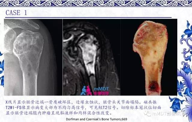 【PPT】长骨骨端髓内肿瘤的影像学诊断
