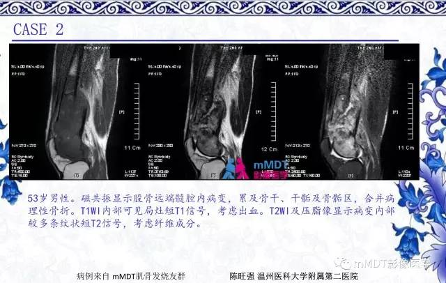 【PPT】长骨骨端髓内肿瘤的影像学诊断