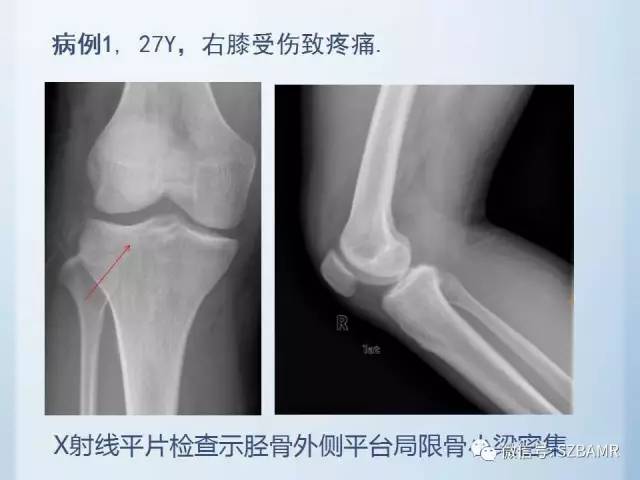 【PPT】隐匿性骨折MR诊断