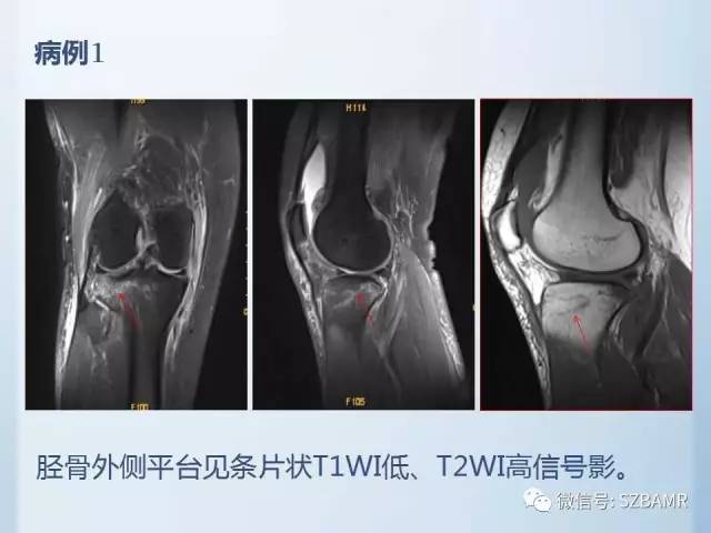 【PPT】隐匿性骨折MR诊断