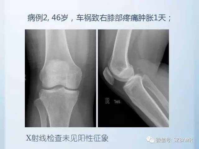 【PPT】隐匿性骨折MR诊断