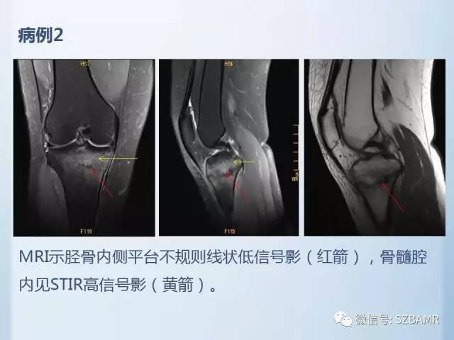【PPT】隐匿性骨折MR诊断