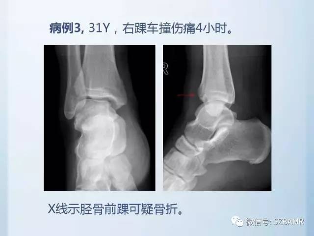 【PPT】隐匿性骨折MR诊断
