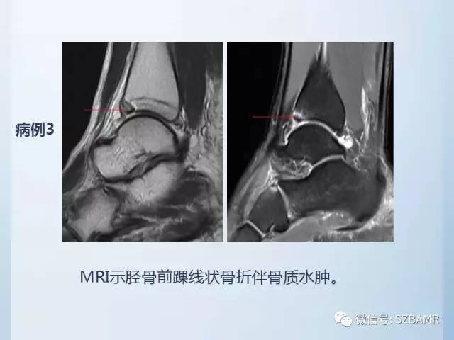 【PPT】隐匿性骨折MR诊断
