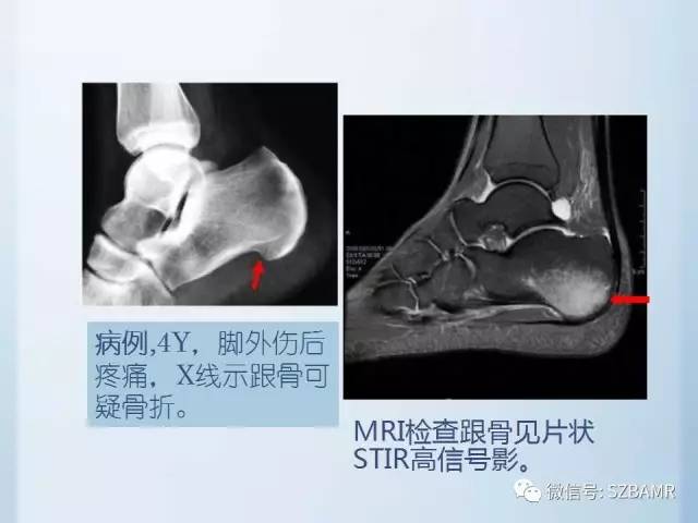 【PPT】隐匿性骨折MR诊断