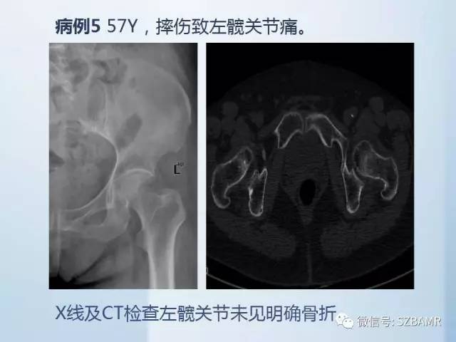 【PPT】隐匿性骨折MR诊断
