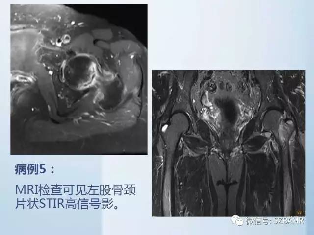 【PPT】隐匿性骨折MR诊断