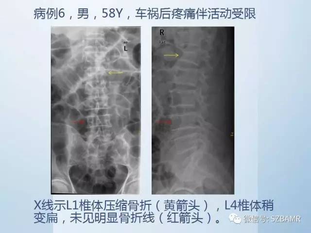 【PPT】隐匿性骨折MR诊断