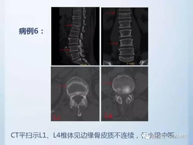 【PPT】隐匿性骨折MR诊断
