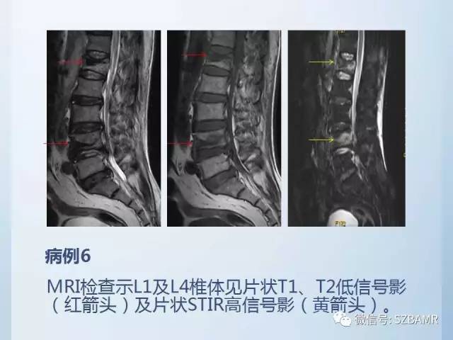 【PPT】隐匿性骨折MR诊断