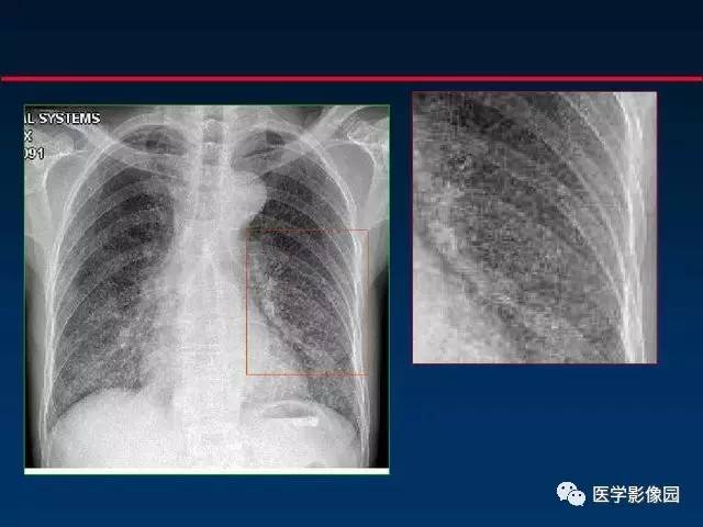 【PPT】血行播散性肺结核的影像诊断与鉴别