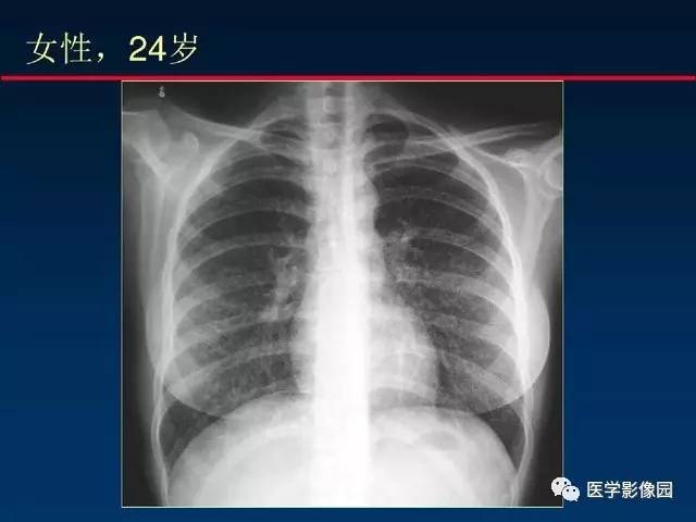 【PPT】血行播散性肺结核的影像诊断与鉴别