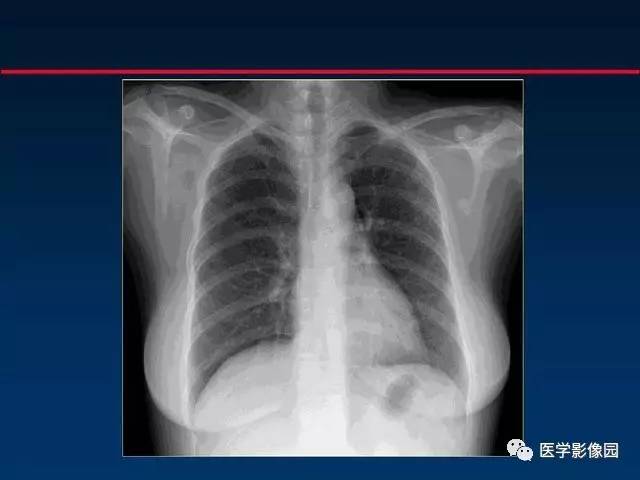 【PPT】血行播散性肺结核的影像诊断与鉴别