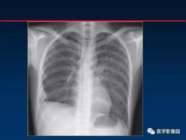 【PPT】血行播散性肺结核的影像诊断与鉴别