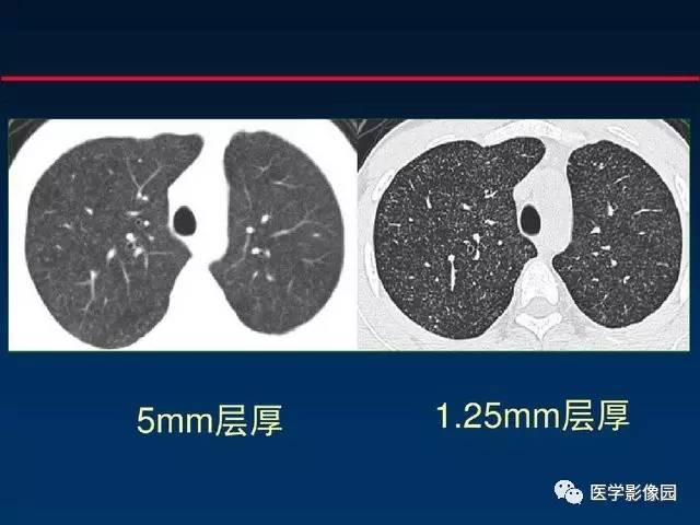 【PPT】血行播散性肺结核的影像诊断与鉴别