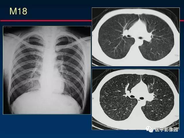 【PPT】血行播散性肺结核的影像诊断与鉴别