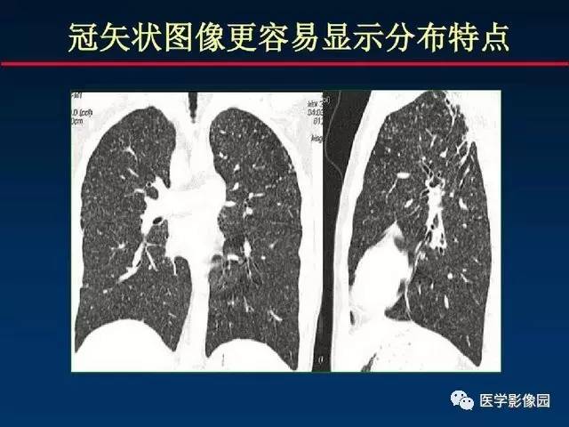 【PPT】血行播散性肺结核的影像诊断与鉴别