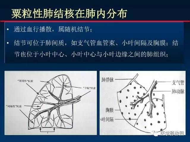 【PPT】血行播散性肺结核的影像诊断与鉴别