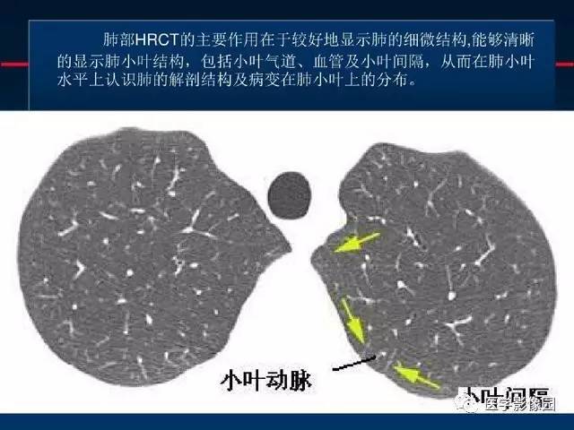 【PPT】血行播散性肺结核的影像诊断与鉴别