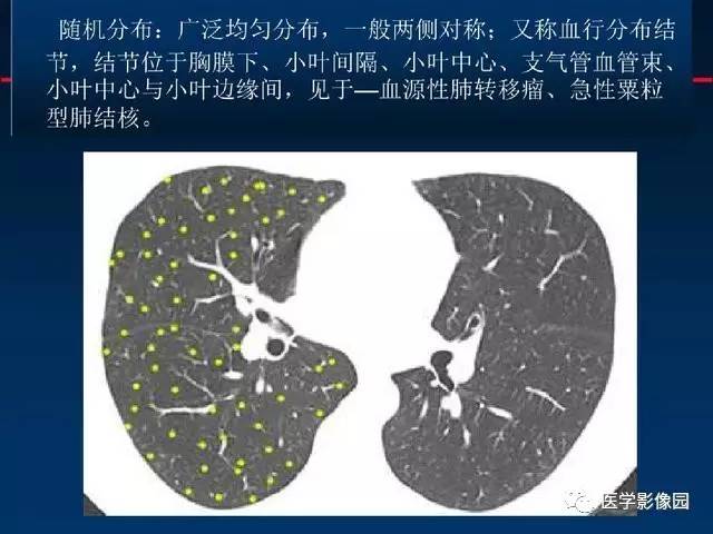 【PPT】血行播散性肺结核的影像诊断与鉴别