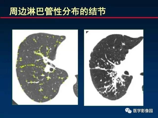【PPT】血行播散性肺结核的影像诊断与鉴别