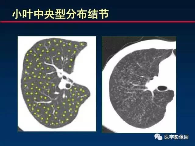 【PPT】血行播散性肺结核的影像诊断与鉴别