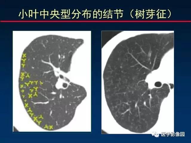 【PPT】血行播散性肺结核的影像诊断与鉴别