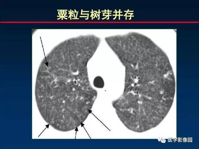 【PPT】血行播散性肺结核的影像诊断与鉴别