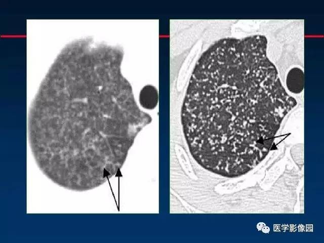 【PPT】血行播散性肺结核的影像诊断与鉴别