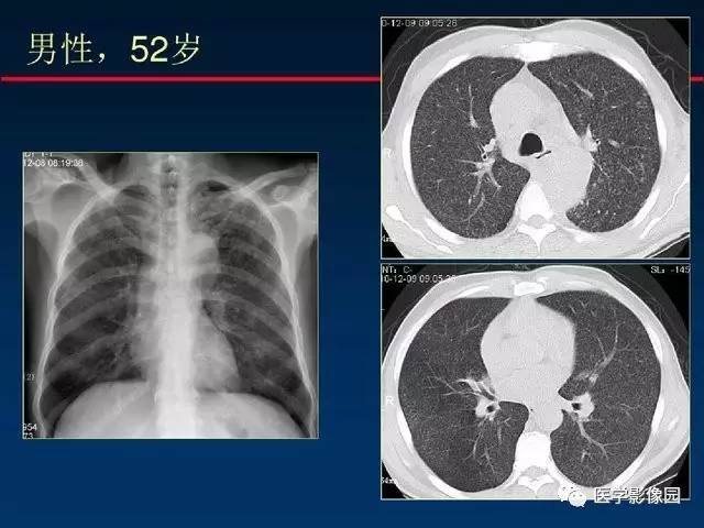 【PPT】血行播散性肺结核的影像诊断与鉴别