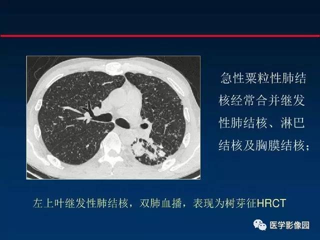 【PPT】血行播散性肺结核的影像诊断与鉴别