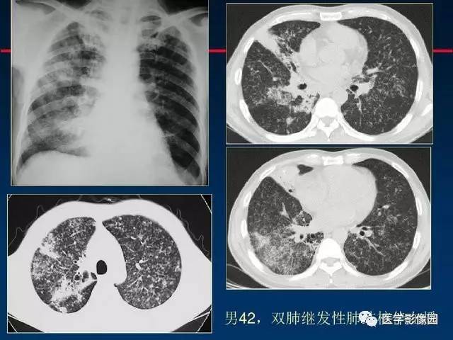 【PPT】血行播散性肺结核的影像诊断与鉴别
