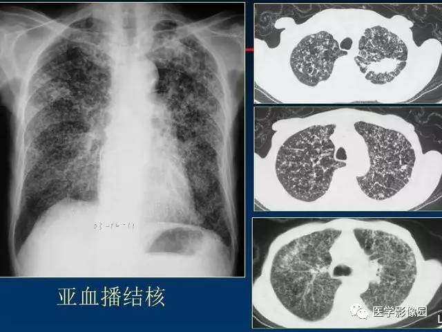 【PPT】血行播散性肺结核的影像诊断与鉴别