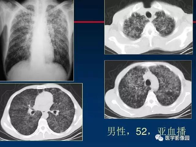 【PPT】血行播散性肺结核的影像诊断与鉴别