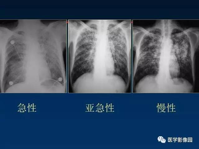 【PPT】血行播散性肺结核的影像诊断与鉴别