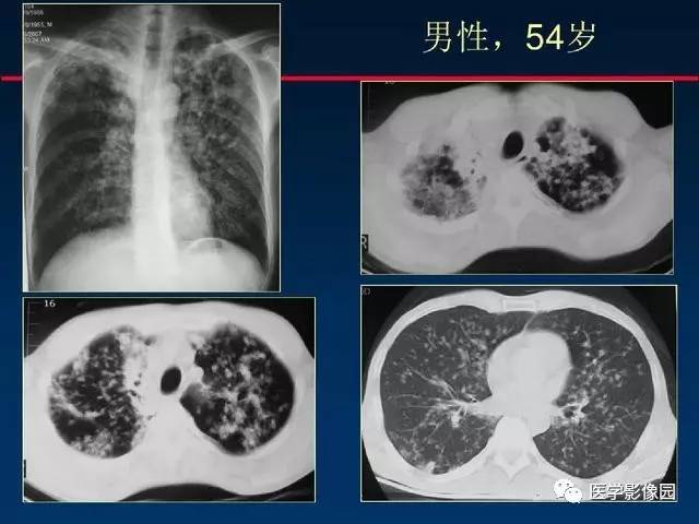 【PPT】血行播散性肺结核的影像诊断与鉴别