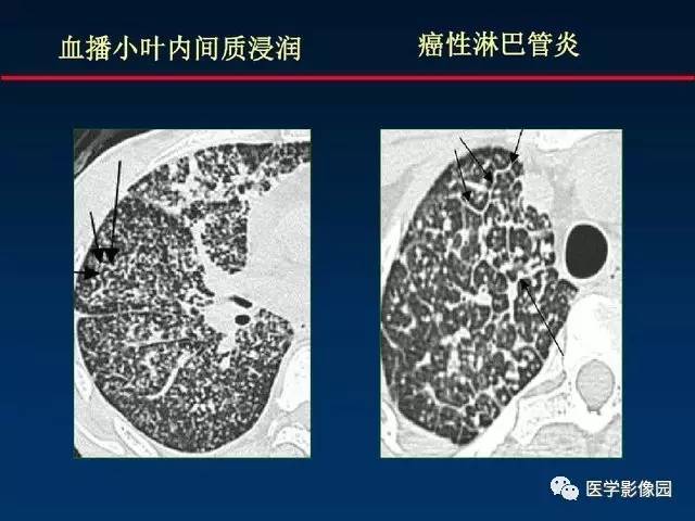 【PPT】血行播散性肺结核的影像诊断与鉴别