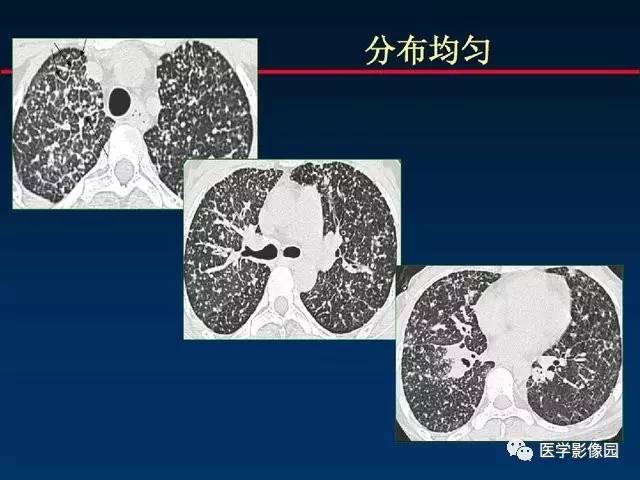 【PPT】血行播散性肺结核的影像诊断与鉴别